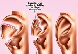 EAR SURGERY