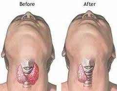 THROAT SURGERY