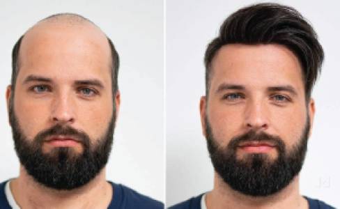Hair Replacement