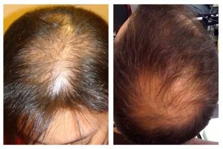 Male & Female Pattern Baldness