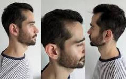 Hair Replacement