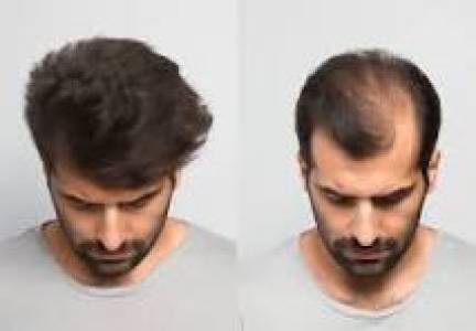 Hair Grow Treatment