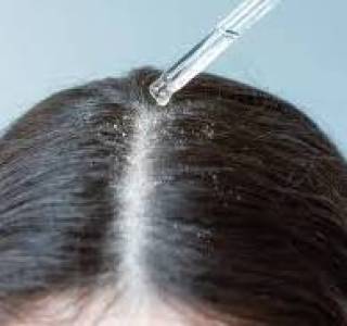 Dandruff Treatment
