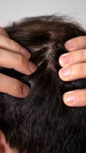 Anti-Dandruff Treatments