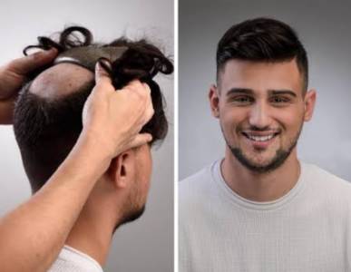 Hair Replacement (Hair Bonding)
