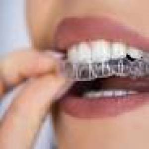 Invisalign & Aligners