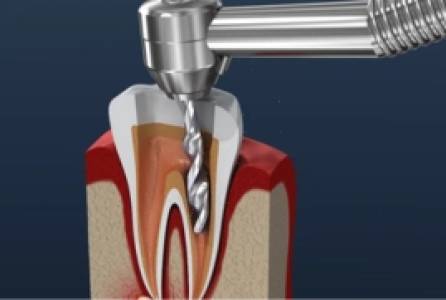 Root Canal Treatment
