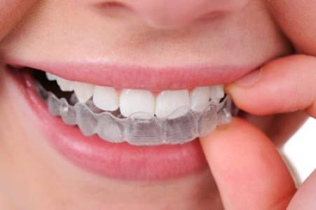 Clear Aligners
