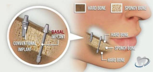 BASAL Implants