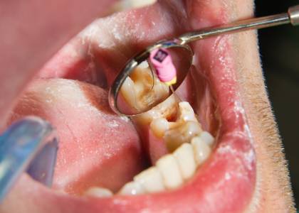root canal treatment