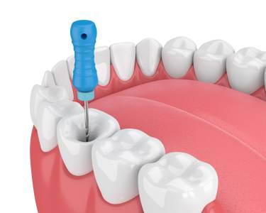 Dental Implants