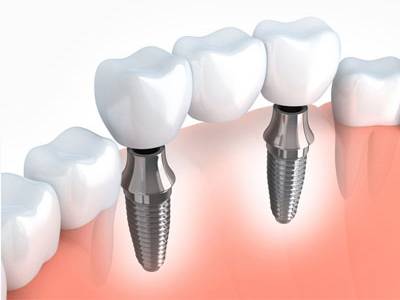 Dental Implants / Teeth Implants