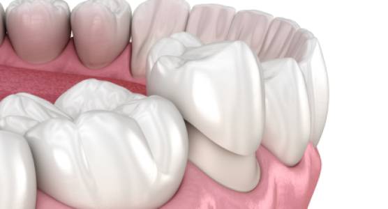 Dental Crowns