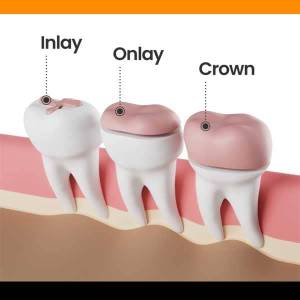 Metal-Free Crowns & Bridges