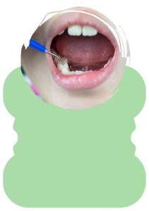 Pit Fissure Sealant in Hyderabad