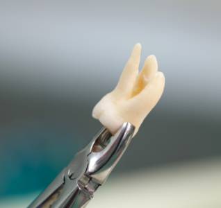 Wisdom Tooth Extractions