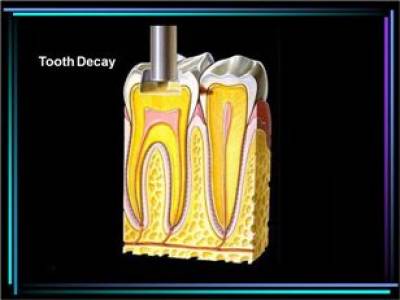 Root Canal Treatment