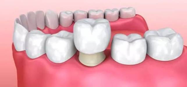 Dental implants