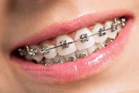 Braces for Children