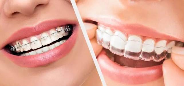 Braces And Aligners