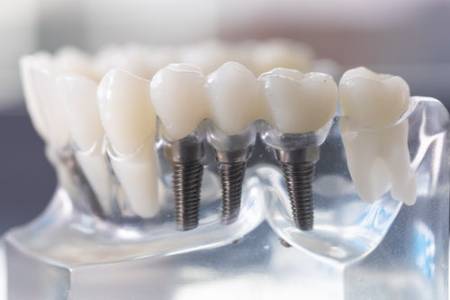 Dental Implant