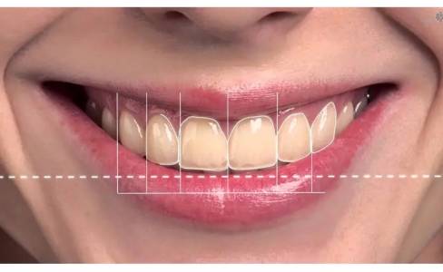 Smile Design and Correction