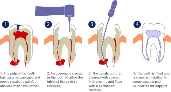 Root Canal Treatment,  maxillofacial surgery , Jaw Joint Disorders