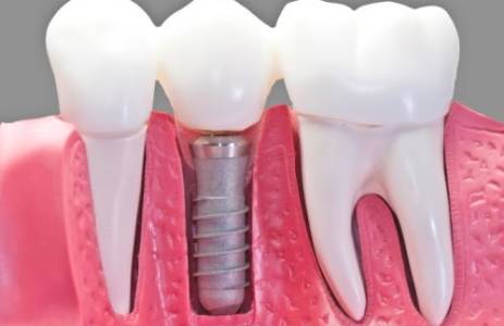 DENTAL IMPLANTS