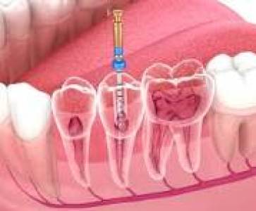 Endodontist