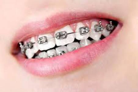 Braces And Aligners