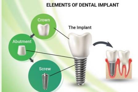 Dental Implants