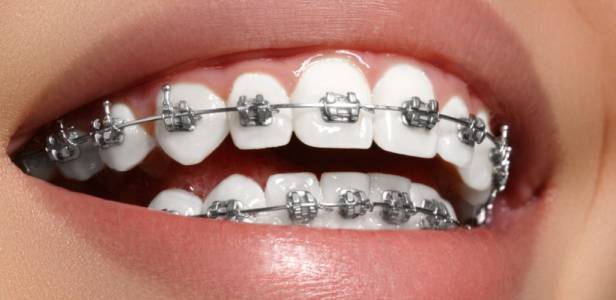 Metal Braces