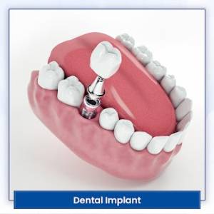 Dental Implant