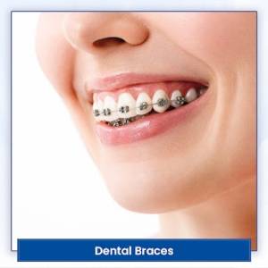 Dental Braces