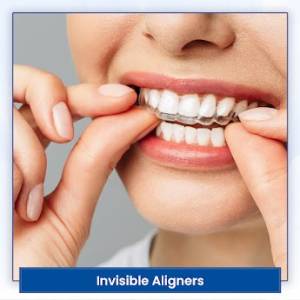 Clear Aligners