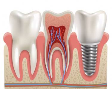 Dental Implants