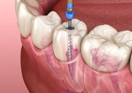 Root Canal Treatment (RCT)