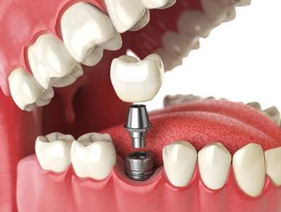 Dental Implants Treatment