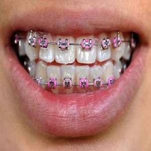 Braces Treatment