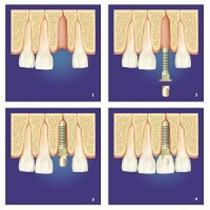 Dental Implants Treatment