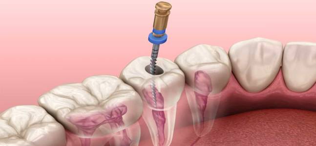 Root Canal Treatment