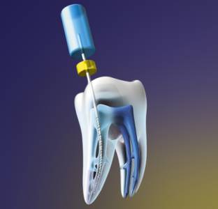 Root Canal Treatment