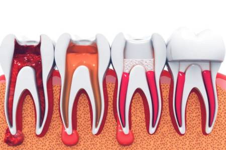 Root Canal Treatment