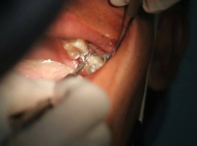 Painless Root Canals