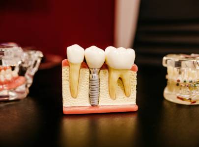 Dental Implants