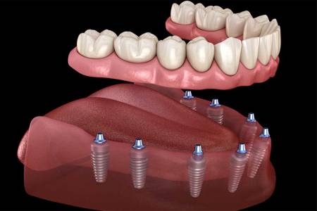 ADVANCED DENTAL IMPLANTS