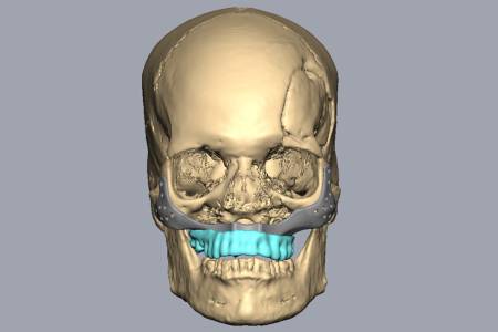 BLACK FUNGUS AND ORAL CANCER REHABILITATION