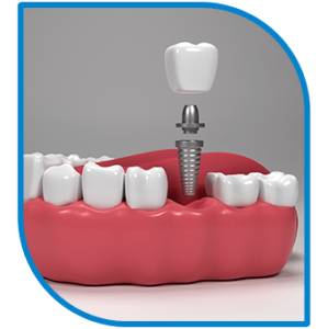 Dental Implants
