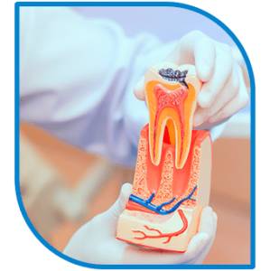 Root Canal Treatment