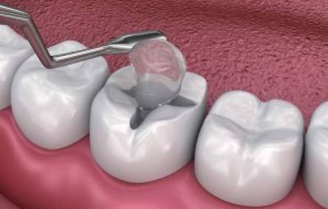 Dental Fillings